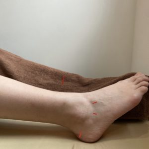 神戸三田やわら整骨院の足首の痛みがある患者様の鍼灸治療の風景