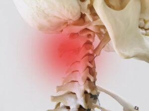 頸椎症や頸椎椎間板ヘルニアになって首に炎症が出ている画像