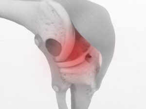 膝半月板損傷・靱帯損傷で膝に痛み・炎症がでている画像